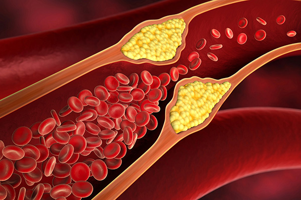 Protocol terapeutic integrat pentru protecție cardiovasculară și reducerea riscului aterosclerotic