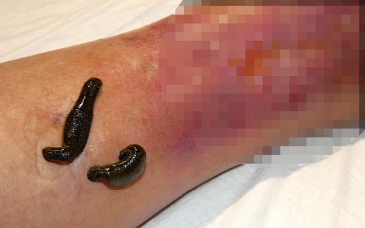 Hirudoterapia în ulcerul venos – rolul microcirculației și al stazei venoase în procesul de vindecare